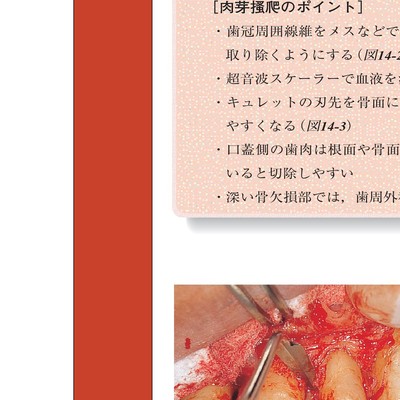 コンセプトを持った予知性の高い歯周外科処置