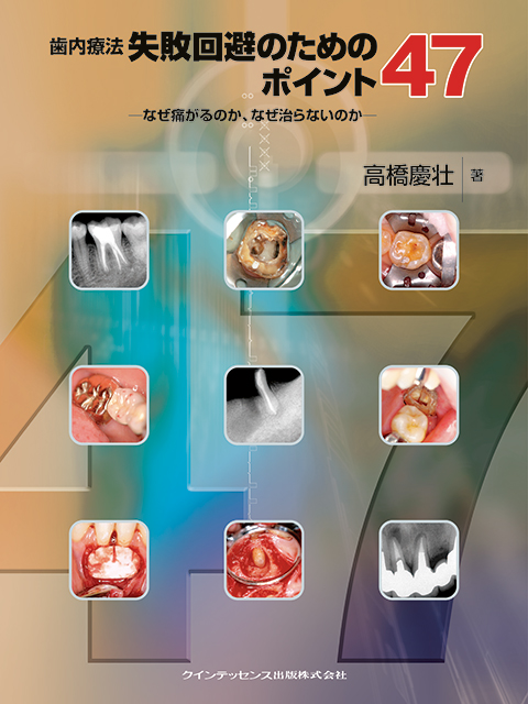 智歯の抜歯ナビゲーション - クインテッセンス出版