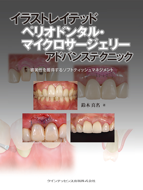 イラストレイテッド 歯冠修復 アドバンステクニック