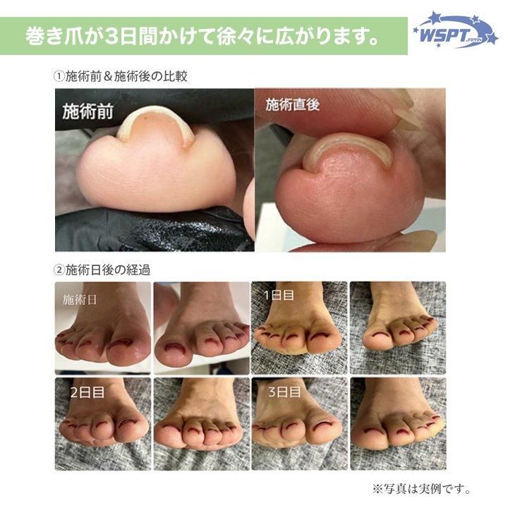 鯨岡先生おすすめ！】 巻き爪ケア フラットケアジェル 3本セット