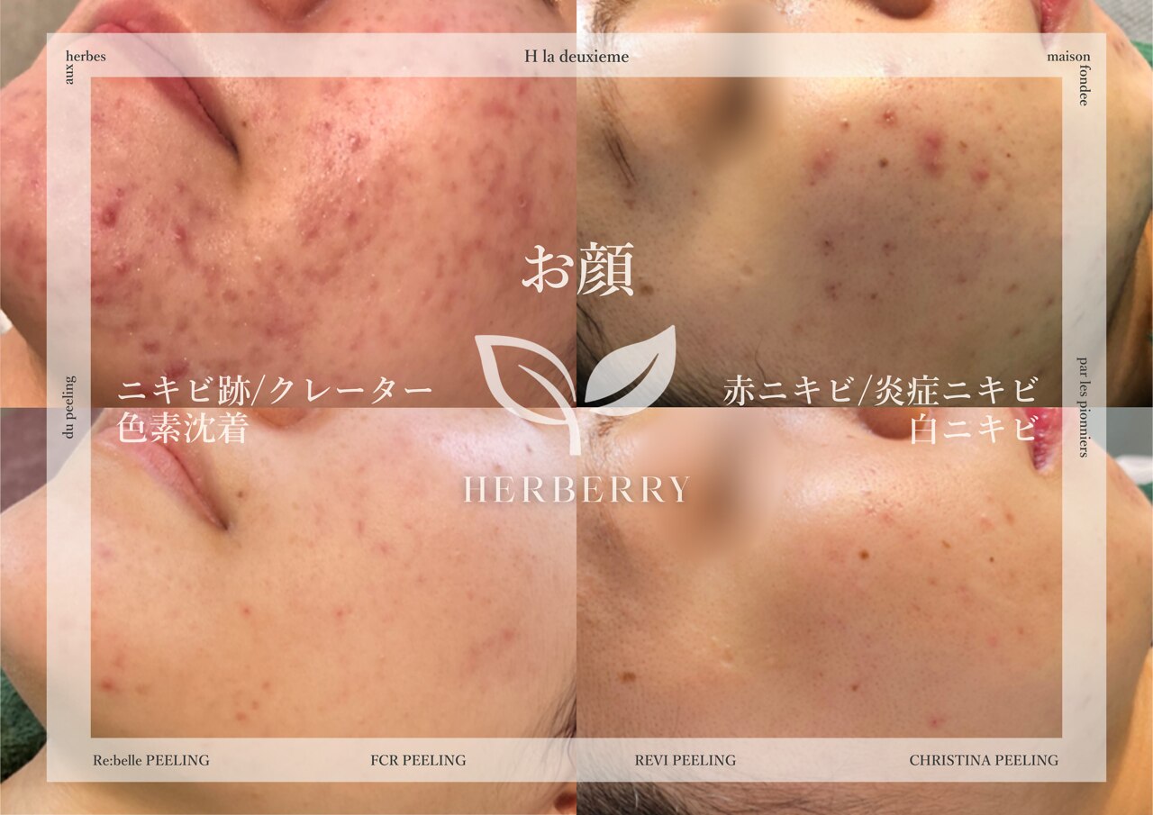 ハーバリー ハーブピーリング 名古屋店(HERBERRYハーブピーリング