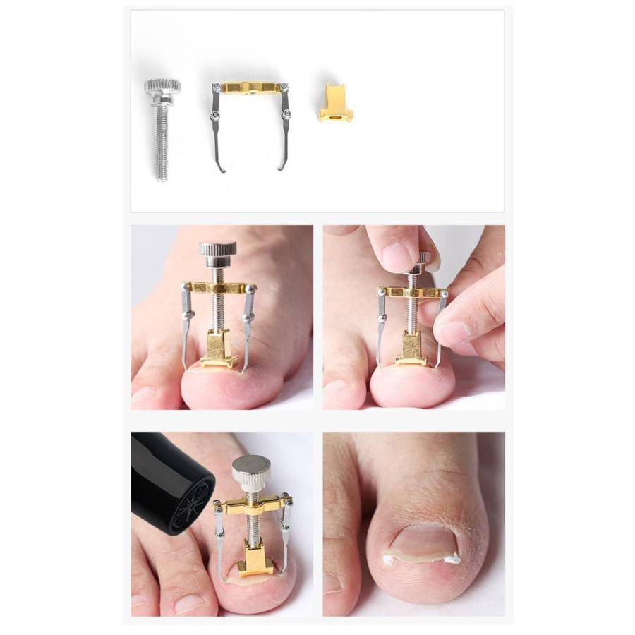 セット ネイル セルフケア 巻爪ケア 巻爪 防止 対策 まき爪 巻き爪