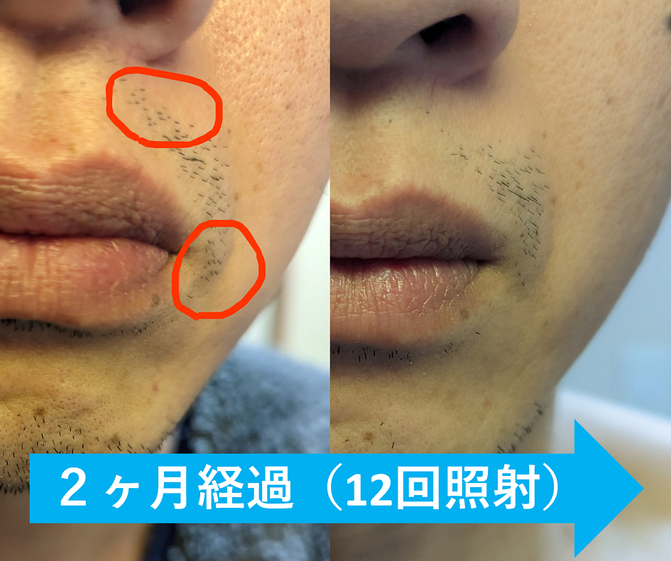 ケノンのバージョン、新旧の主な違いまとめ | 自分で脱毛ドットコム