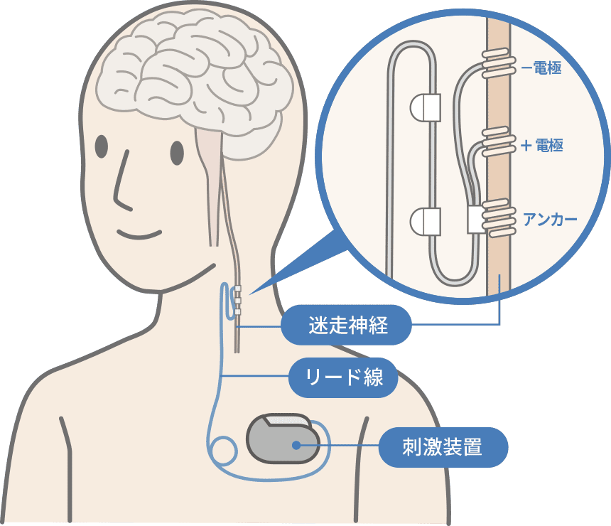 てんかん（てんかん・難治性てんかん）の症状と治療法 - 一般社団法人