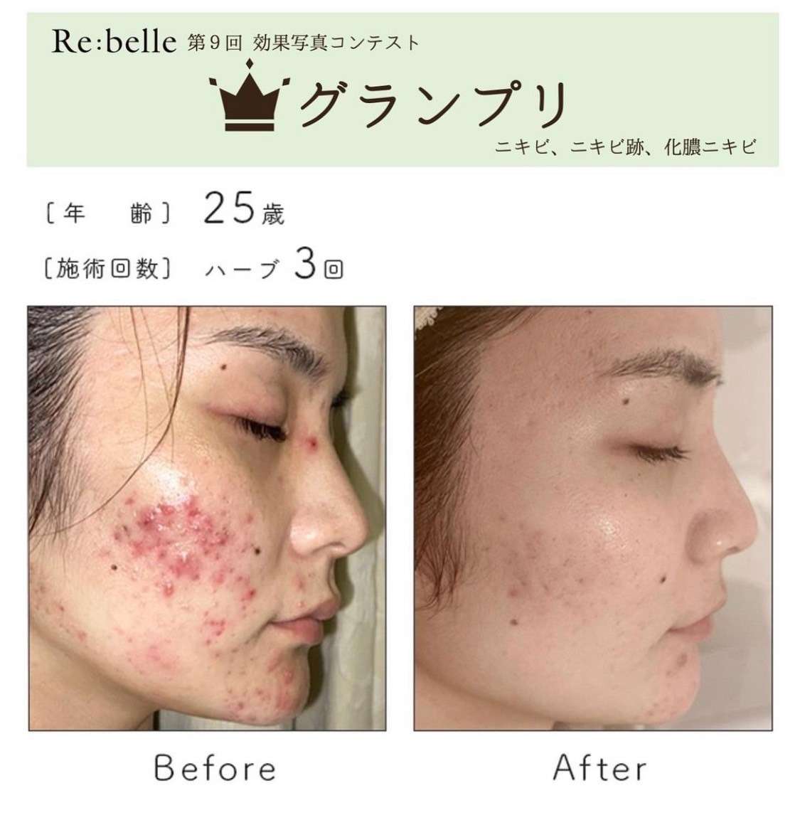 剥離のあるリベルハーブピーリングの効果と特徴とは | ブログ | 那覇の