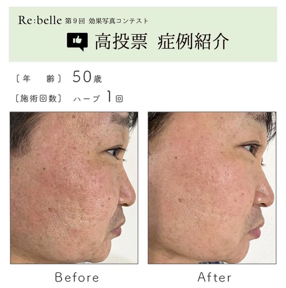 肌代謝を促進！リベルハーブピーリングで肌トラブルを解決！ | ブログ