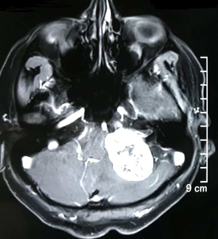 聴神経腫瘍とは | 頭蓋底専門 脳神経外科医 大森一美 | 兵庫 関西 頭蓋