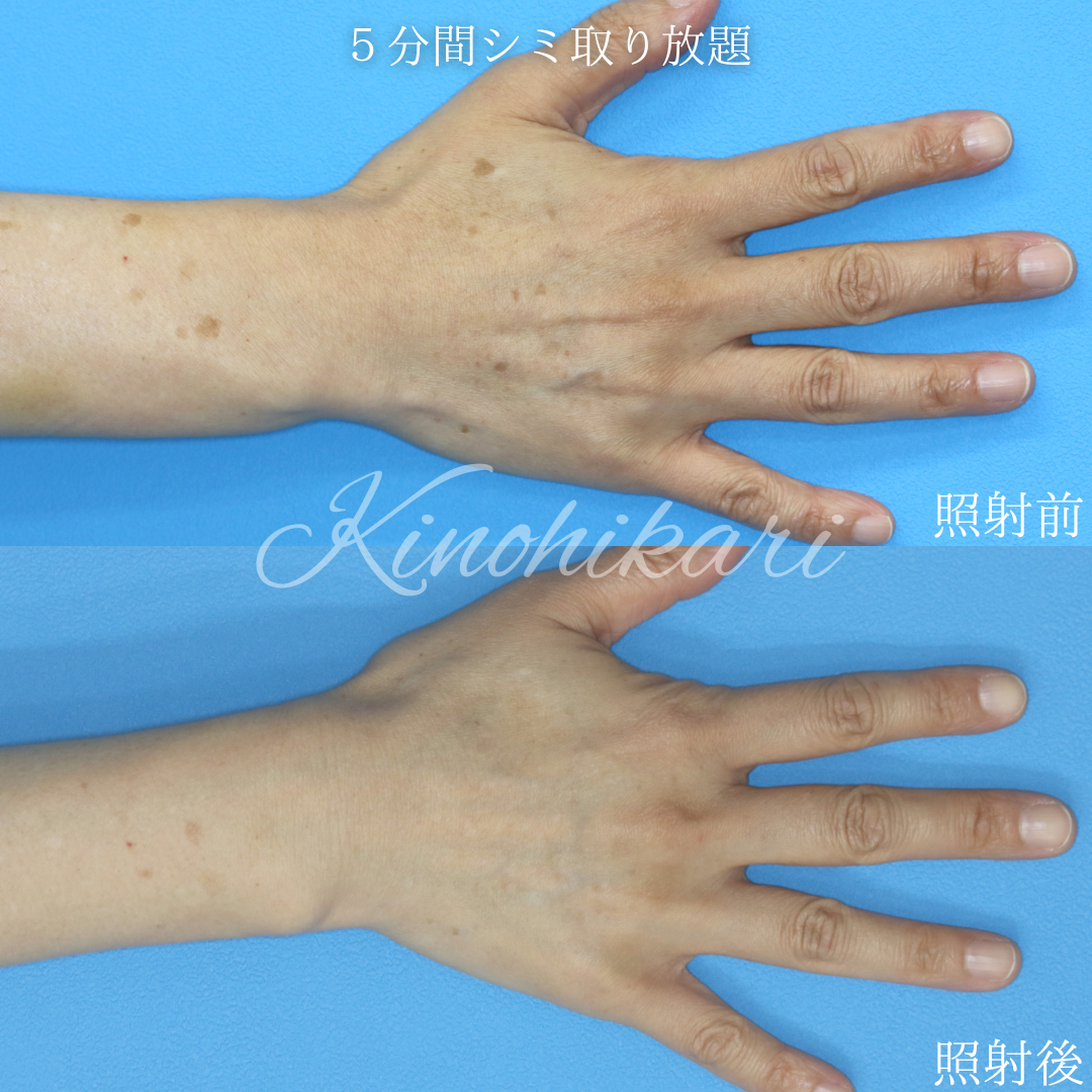 5分間シミ取り放題】腕や手背のしみ、アンチエイジング！ 50代女性