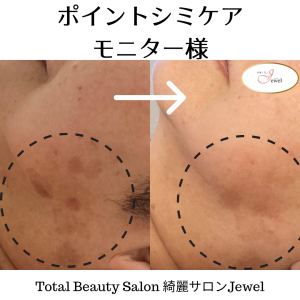 20分間🔹シミ取り放題🔹低周波で集中シミケア🔹横浜市都筑区センター北