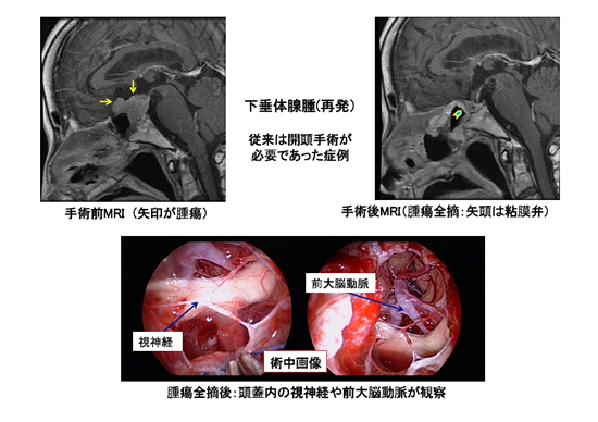 経鼻内視鏡頭蓋底手術（改訂） | KOMPAS – 慶應義塾大学病院 医療