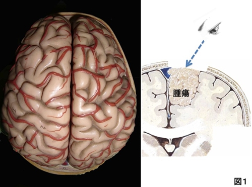 頭蓋底腫瘍 | KOMPAS – 慶應義塾大学病院 医療・健康情報サイト