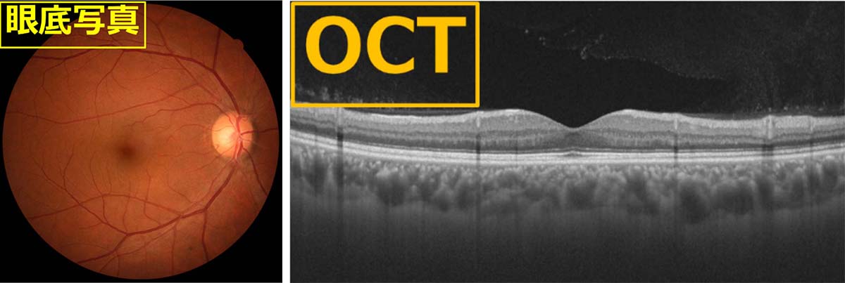 加齢黄斑変性の原因・治療方法｜茨城県水戸市の小沢眼科内科病院