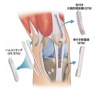 Hybrid前十字靭帯再建術】翌日退院｜横浜整形外科｜関節鏡手術