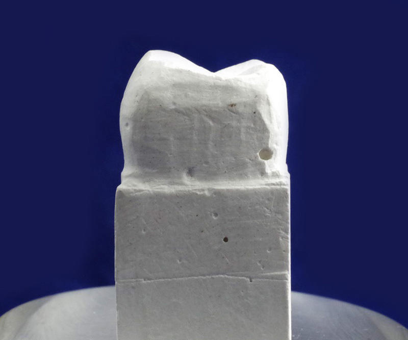 石膏による歯形彫刻が嫌いだった中国の実習生たち: 流浪の歯科技工士