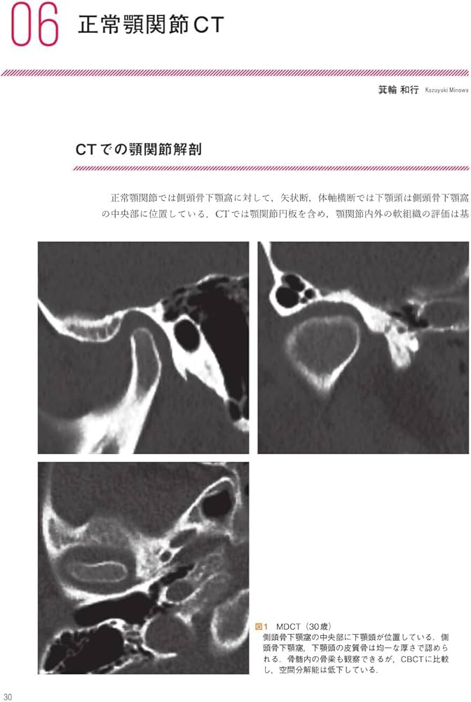 顎関節の画像診断: 臨床医によるMRI・CT読像の手引き | 金田 隆, 箕輪