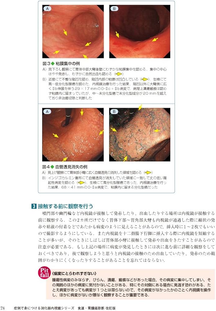 食道・胃腫瘍診断改訂版〜確実な鑑別・深達度診断のためのコツとCase