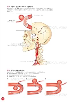 脳血管内治療 スタート&スタンダード | 吉村 紳一 |本 | 通販 | Amazon