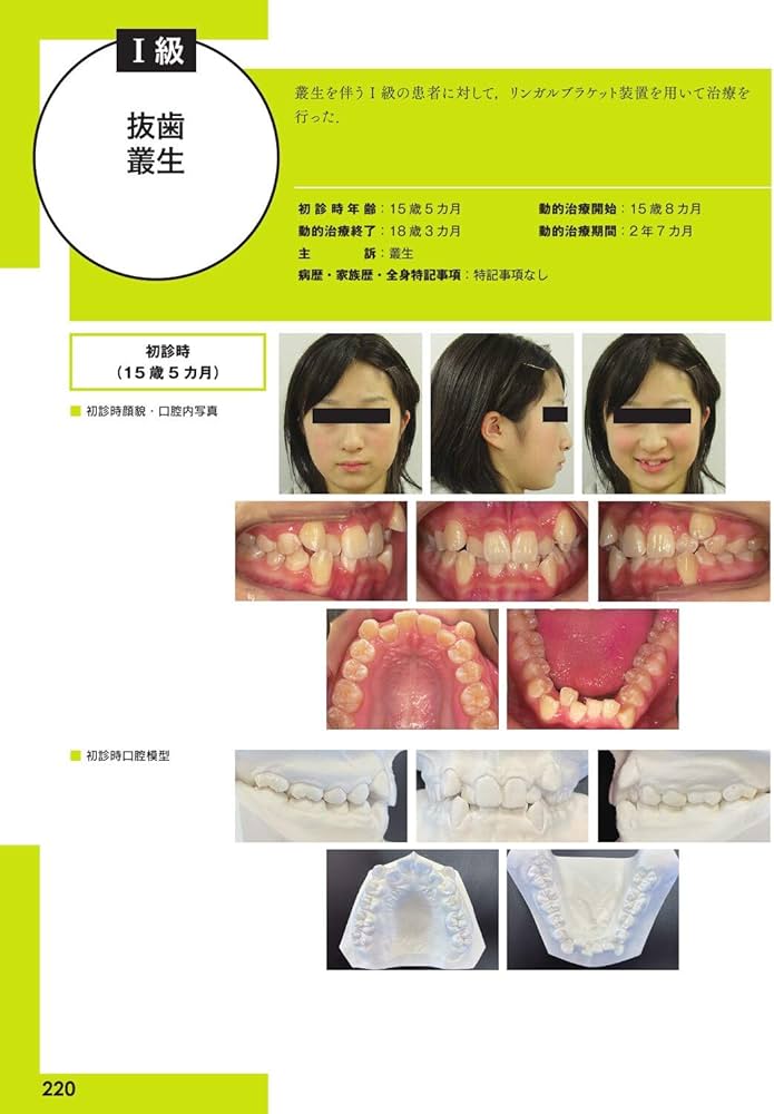 リンガルブランケット矯正の臨床 | 居波 徹, 佐奈 正敏, 相澤 一郎, 椿