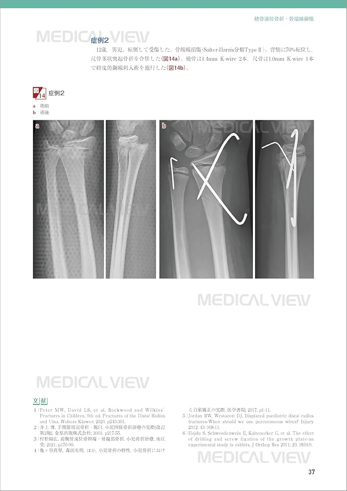 小児の骨折と手術［Web動画付］ (新OS NEXUS) | 大谷 卓也 |本 | 通販