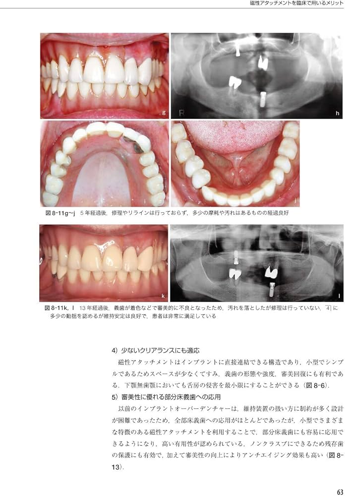新インプラントオーバーデンチャーの基本と臨床 磁性アタッチメントを