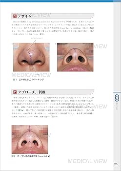 外鼻形成術−機能と形態を両立した手術 | ライノプラスティー研究会