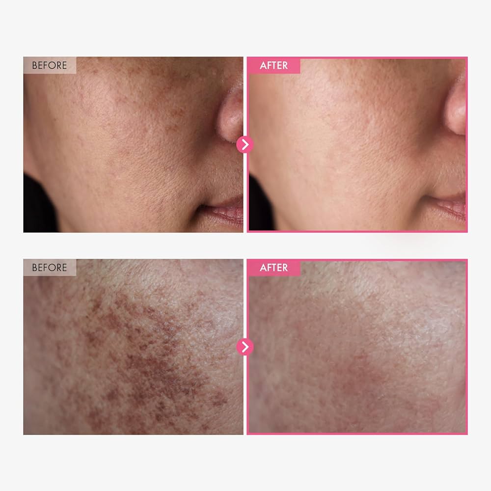 Amazon.com: TOSOWOONG Arbutin 7% + Tranexamic Acid 4% Cream