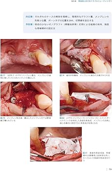 インプラントトラブルの対応策と予防策 | 鈴木 貴規 |本 | 通販 | Amazon