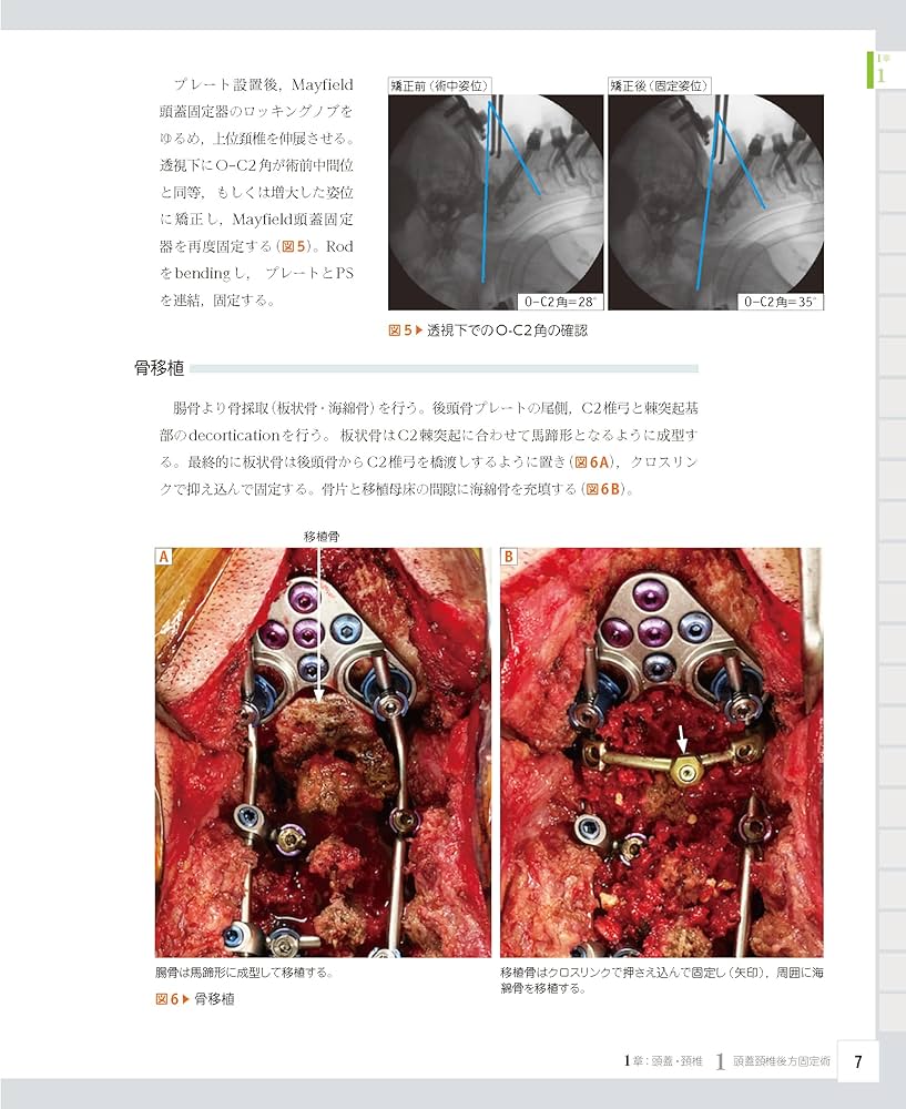 整形外科医のための脊椎のアドバンスト手術 | 石井 賢 |本 | 通販 | Amazon
