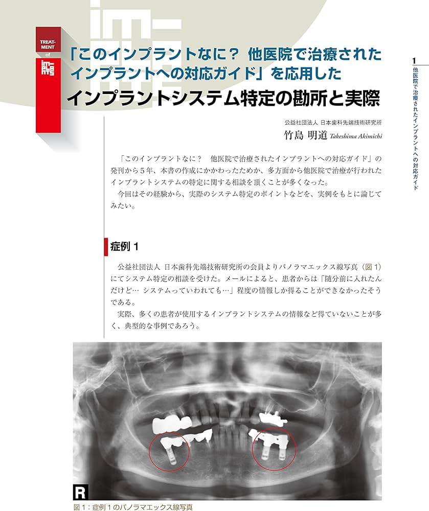 続・このインプラントなに? 他医院で治療されたインプラントへの対応