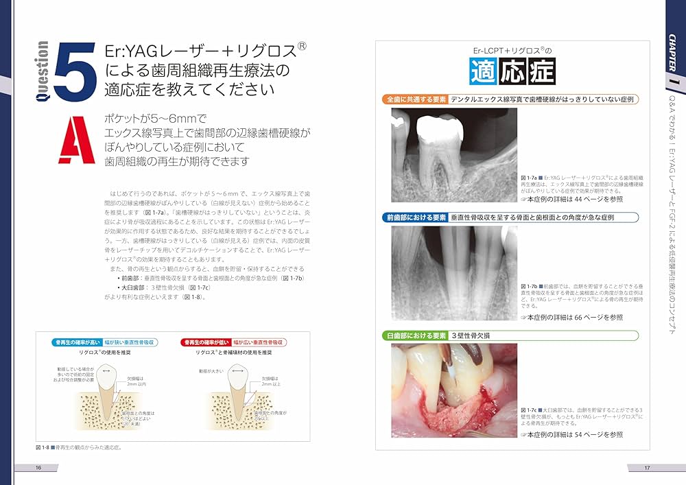 Amazon.co.jp: Er:YAGレーザーとFGF-2による低侵襲再生療法 : 原田