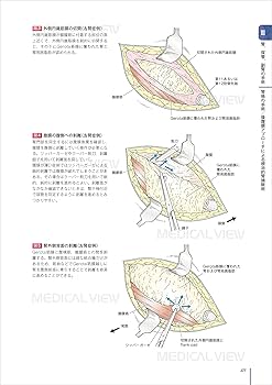 オープンサージャリ一 (Urologic Surgery Next 4) | 土谷 順彦 |本