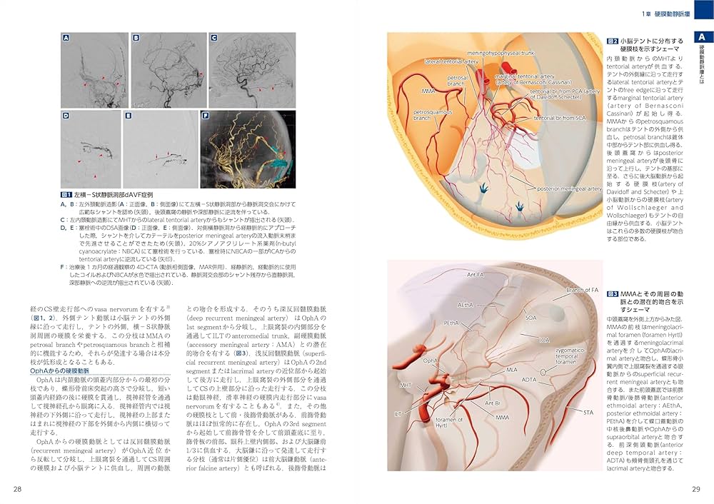 裁断済】dAVF・AVM (脳動静脈奇形) のすべて dAVF・AVM（硬膜動静脈瘻