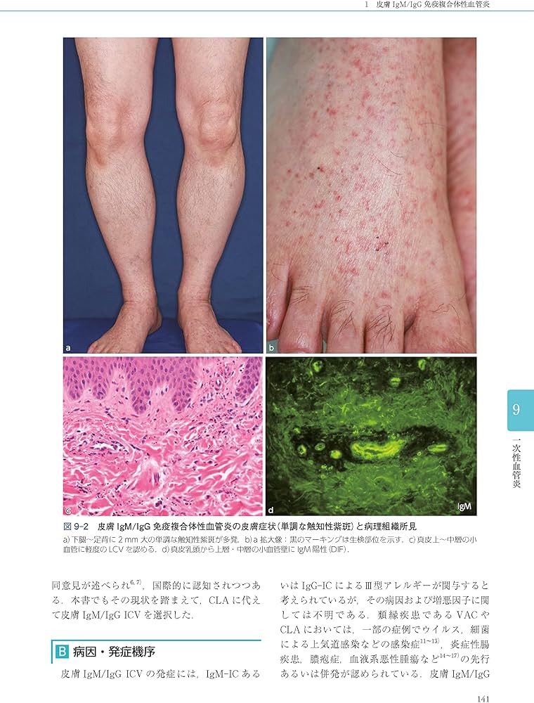 Amazon.co.jp: 皮膚血管炎 第2版 : 川名 誠司, 陳 科榮: 本