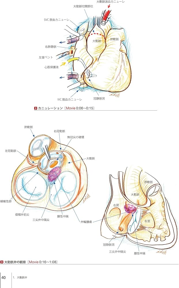 弁膜症の手術 (心臓血管外科手術エクセレンス) | 高梨 秀一郎, 坂東 興