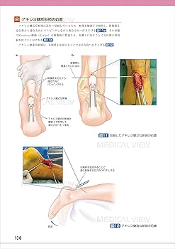 足・足関節の最新の手術 (OS NEXUS(電子版付き) 19) | 中村 茂 |本