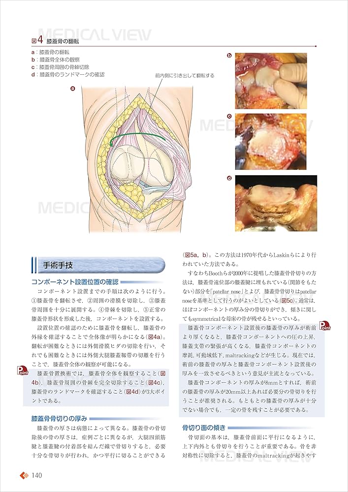 人工膝関節全置換術[TKA]のすべて−より安全に・より確実に | 勝呂 徹
