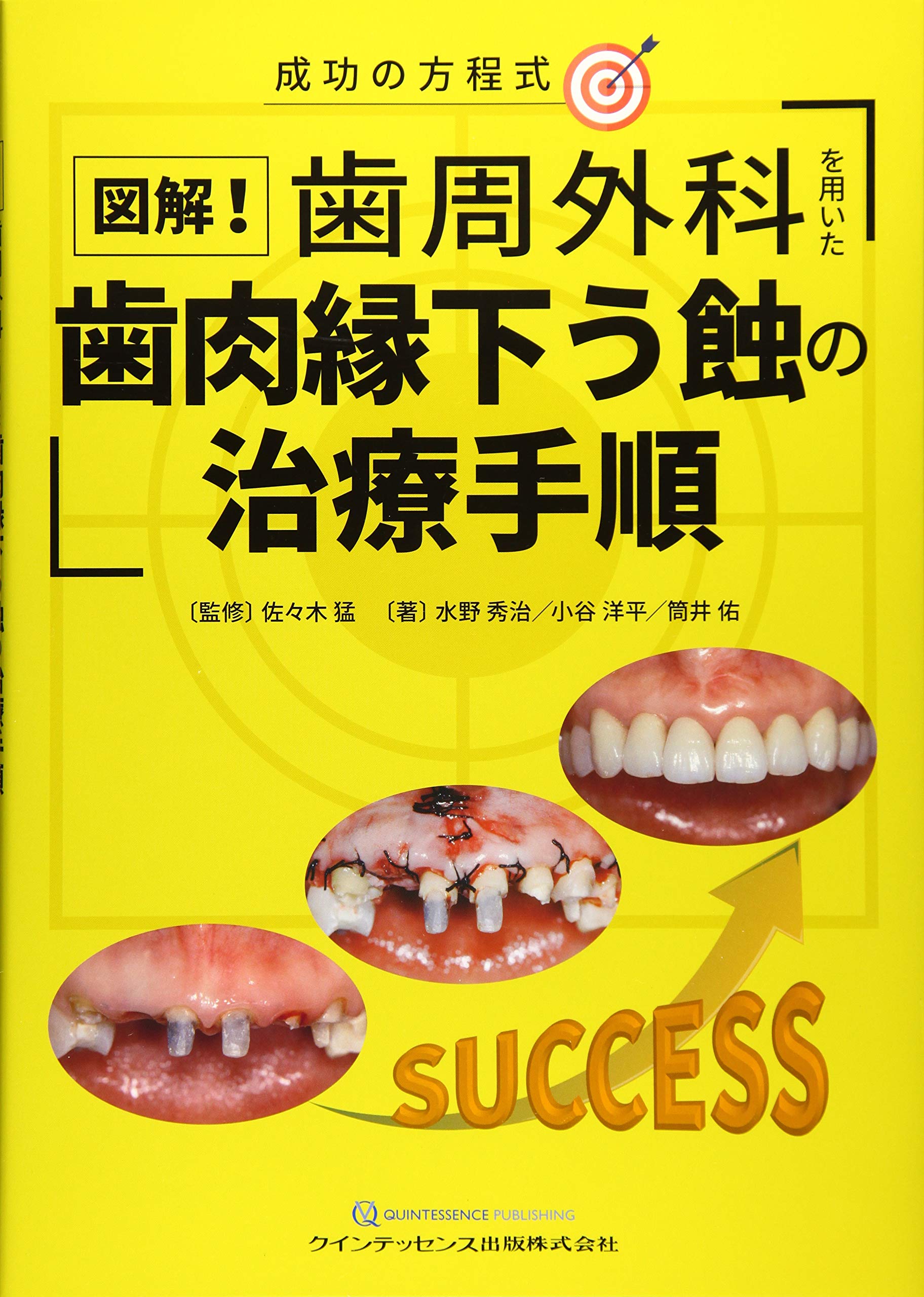 図解！歯周外科を用いた歯肉縁下う蝕の治療手順 | 水野 秀治, 小谷