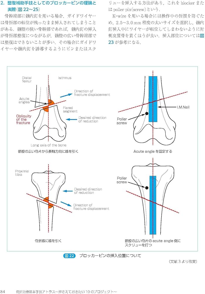 骨折治療基本手技アトラス~押さえておきたい10のプロジェクト | 最上