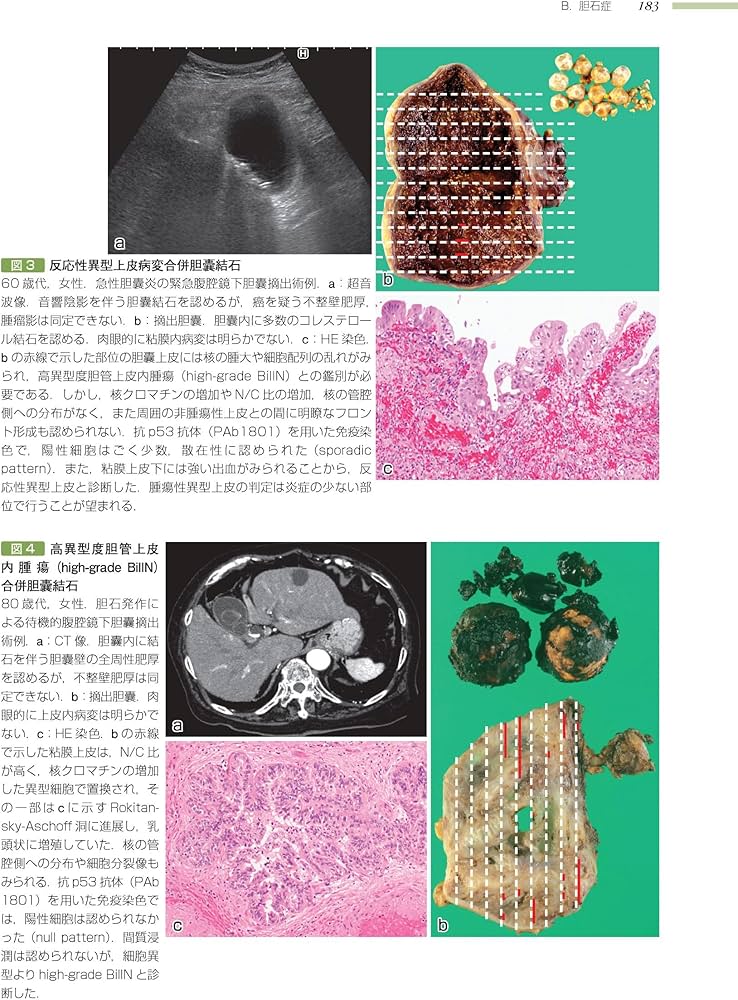 肝胆膵 (非腫瘍性疾患病理アトラス) | 原田 憲一, 能登原 憲司 |本