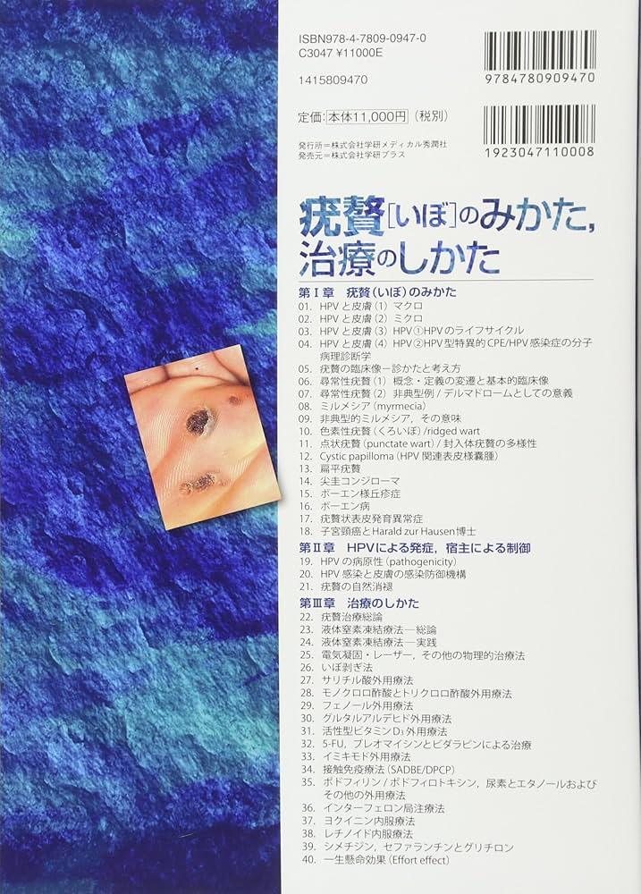 疣贅(いぼ)のみかた,治療のしかた | 江川清文, 江川清文 |本 | 通販