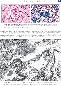 Amazon | Heptinstall's Pathology of the Kidney | Jennette MD, J