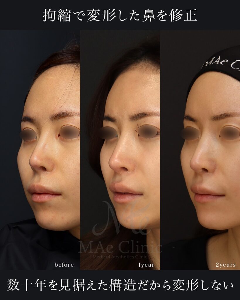 8回目の正直」──拘縮と鼻閉に悩んだ鼻を、再建で呼吸と自然な形に