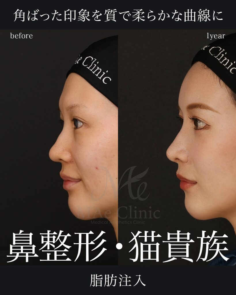 鷲鼻・魔女鼻を改善｜ハンプ切除と肋軟骨で自然な鼻筋に【症例】 | MAe