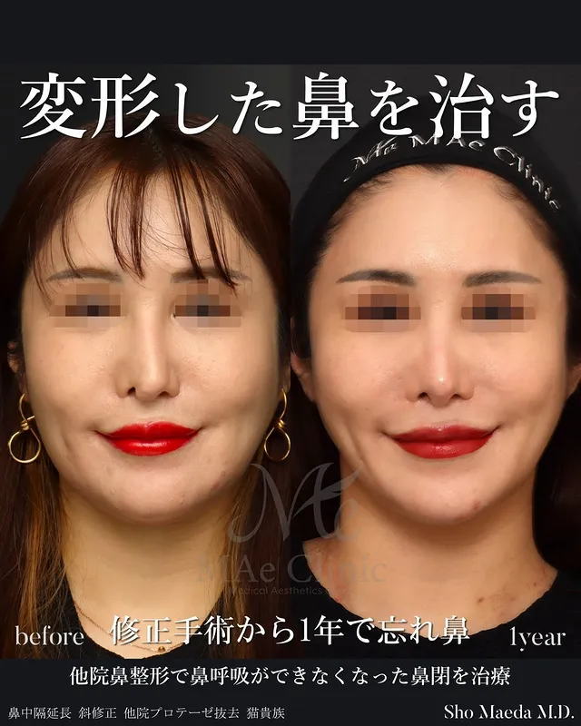 曲がって息ができなくなった鼻の治療【鼻中隔延長、斜鼻修正、猫貴族