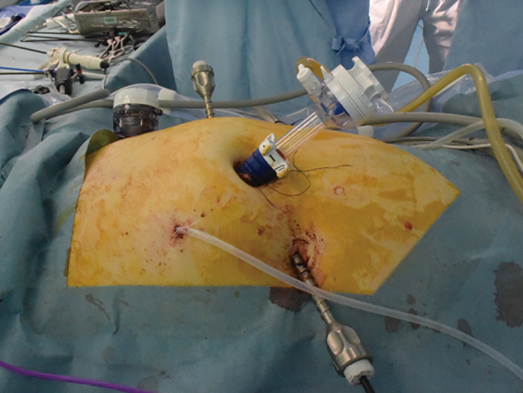 下部消化管疾患に対する積極的な腹腔鏡治療 | 病気と治療の検索サイト