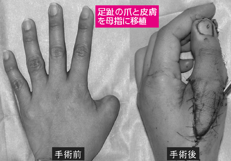 とても大切な「手」の外科治療 | 病気と治療の検索サイト「メディカル