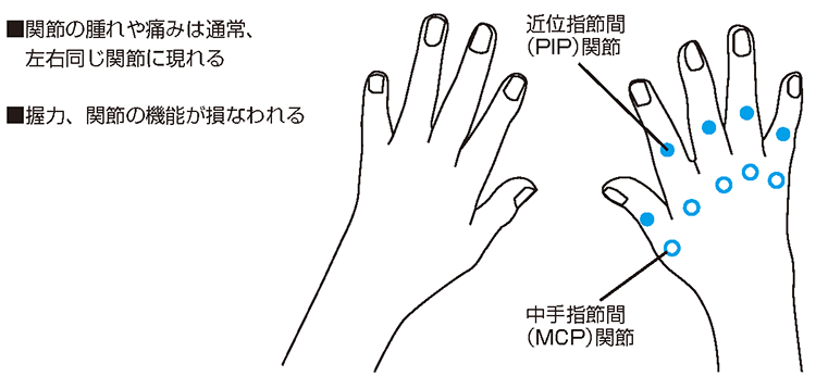 関節の痛み、関節リウマチの早期治療の重要性 | 病気と治療の検索