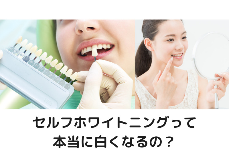 最近流行のセルフホワイトニング、自分でやって本当に白くなるの