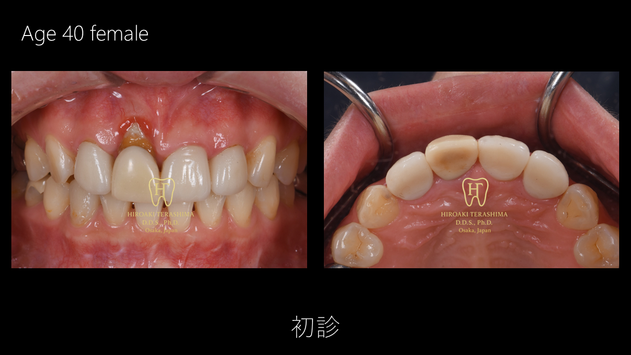 高度な歯肉退縮に対する抜歯即時埋入インプラント治療~難症例~ | 箕面