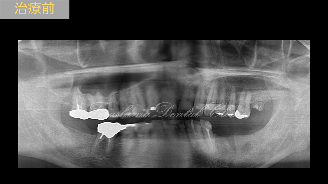 シンプルなインプラントとセラミックの複合治療～60代男性～ | 箕面市